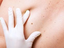 Consultația medicului oncodermatolog